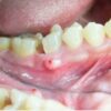 How Do You Know If A Tooth Infection Has Spread To Your Blood?