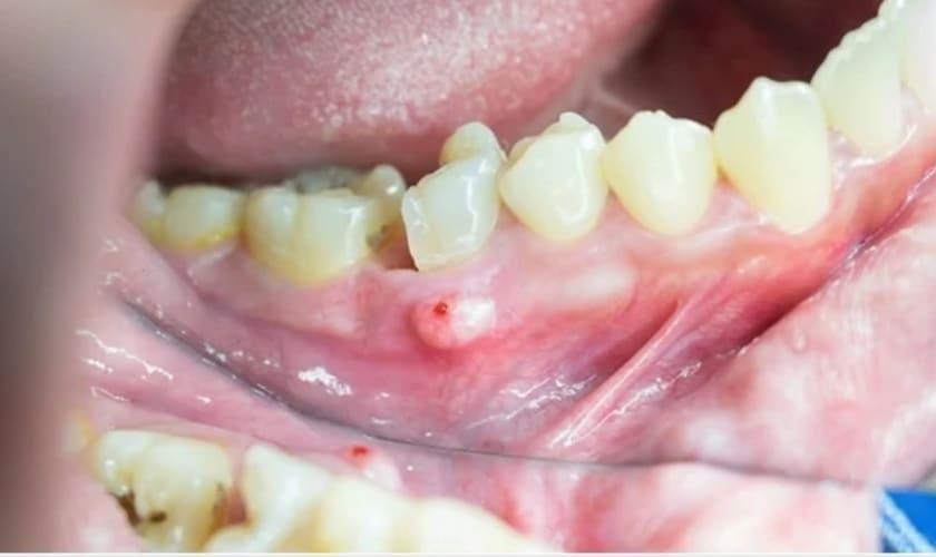 can a tooth infection cause high white blood cell count