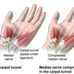 Can Hand Grippers Cause Carpal Tunnel? The Gripping Truth!