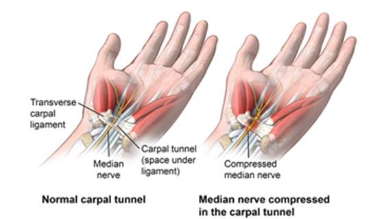 can hand grippers cause carpal tunnel