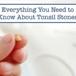 Everything You Need to Know About Tonsil Stones