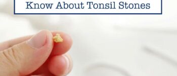 Everything You Need to Know About Tonsil Stones