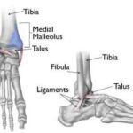 Fractura de tobillo