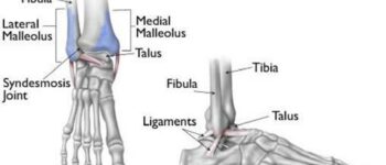 Fractura de tobillo