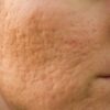 Dermaplaning Vs. Microdermabrasion For Acne Scarring