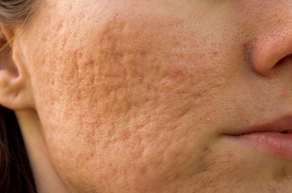 does dermaplaning help acne scars