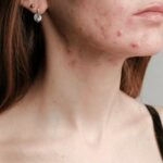 Fungal Acne vs. Closed Comedones