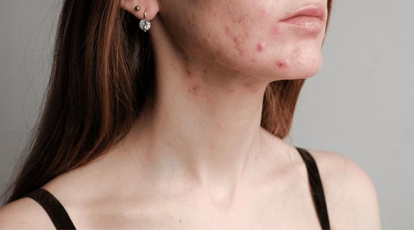 fungal acne or closed comedones