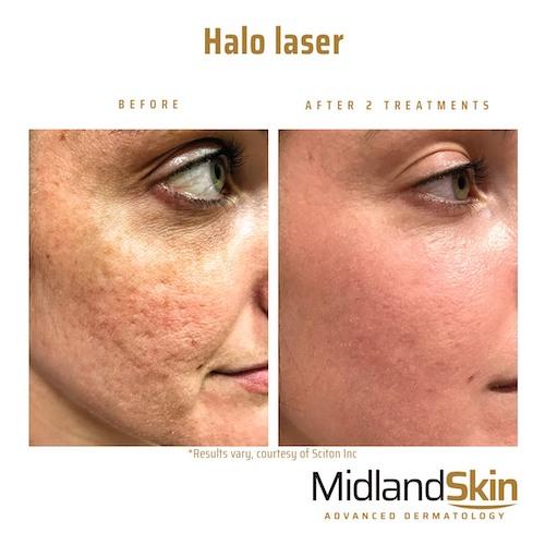 halo laser before and after acne scars