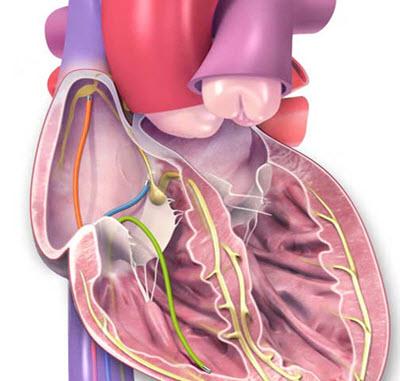 Ablation for Arrhythmias