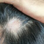 Can a Hair Transplant Be Done on a Scar?