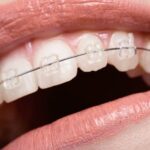 What Should I Do If My Braces Wire Came Out?