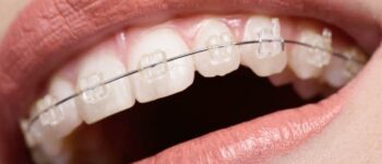 What Should I Do If My Braces Wire Came Out?