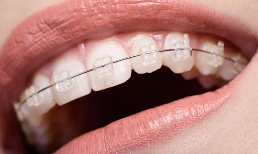 how to put a braces wire back in