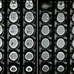 Documenting and Coding Subdural Hematoma – Know the ICD-10 Codes