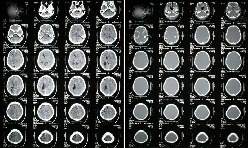 icd 10 code chronic subdural hematoma