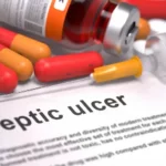 Peptic Ulcer – Symptoms, Diagnosis, and Assigning the Correct ICD-10 Codes