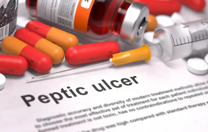 icd 10 code history of peptic ulcer disease