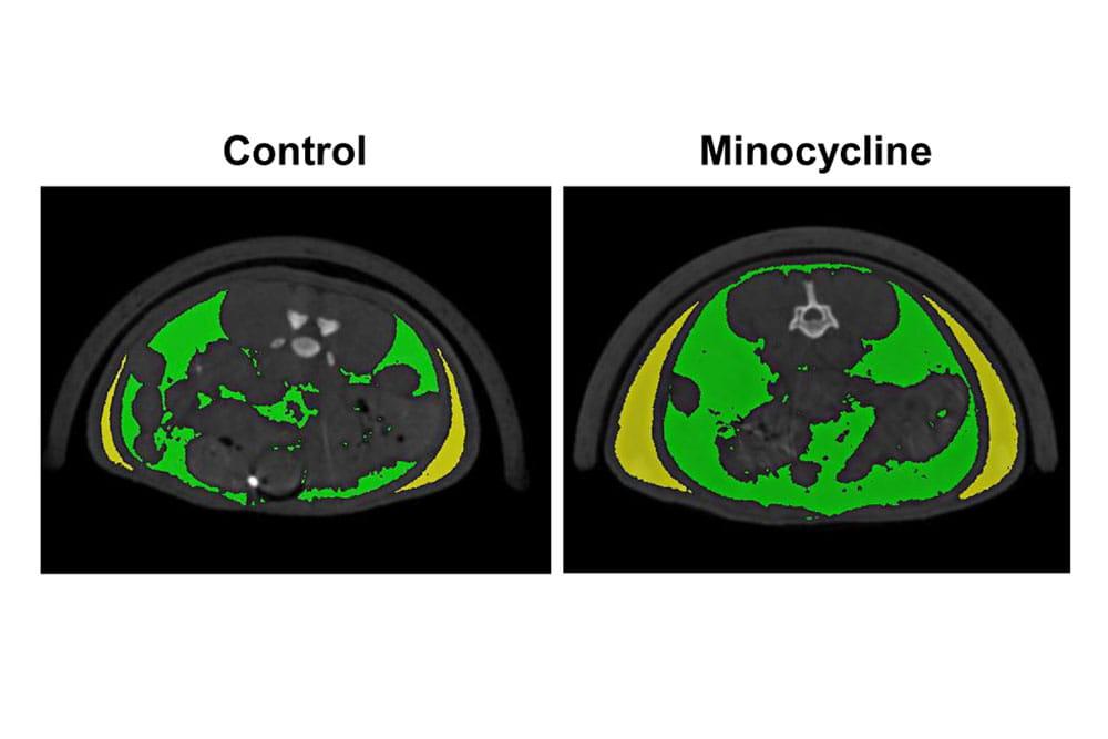 minocycline side effects weight gain