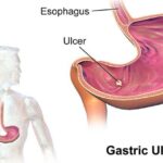 SELFCheck Stomach Ulcer Test