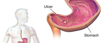 SELFCheck Stomach Ulcer Test