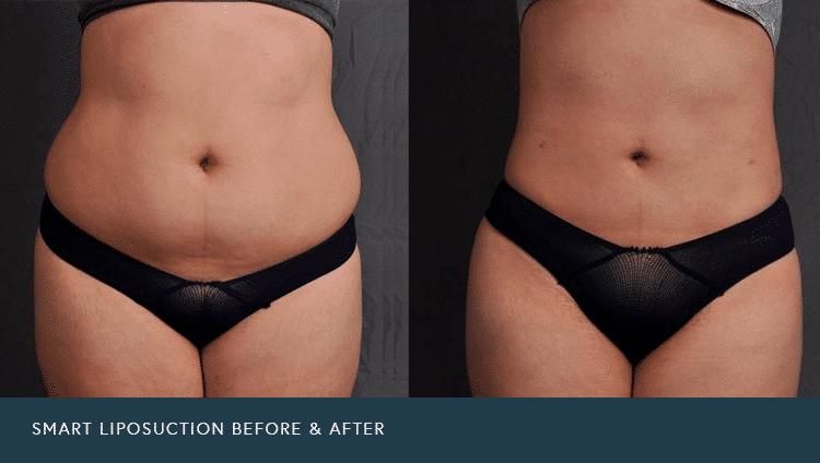 smart liposuction before and after