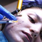 Subcision for Acne Scars