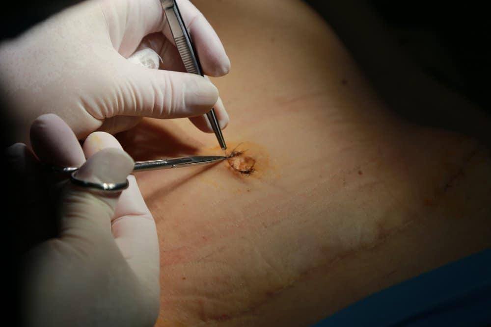 cleaning belly button after tummy tuck