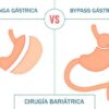 Manga gástrica vs bypass gástrico