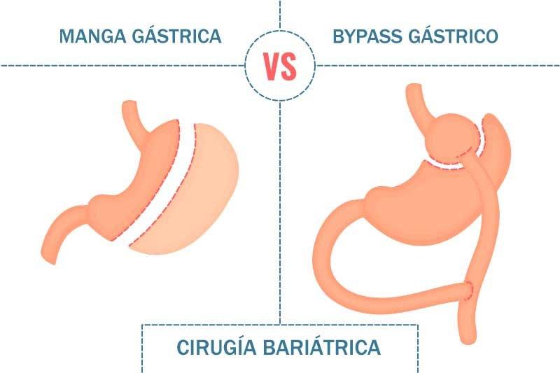 diferencia de bypass y manga gastrica