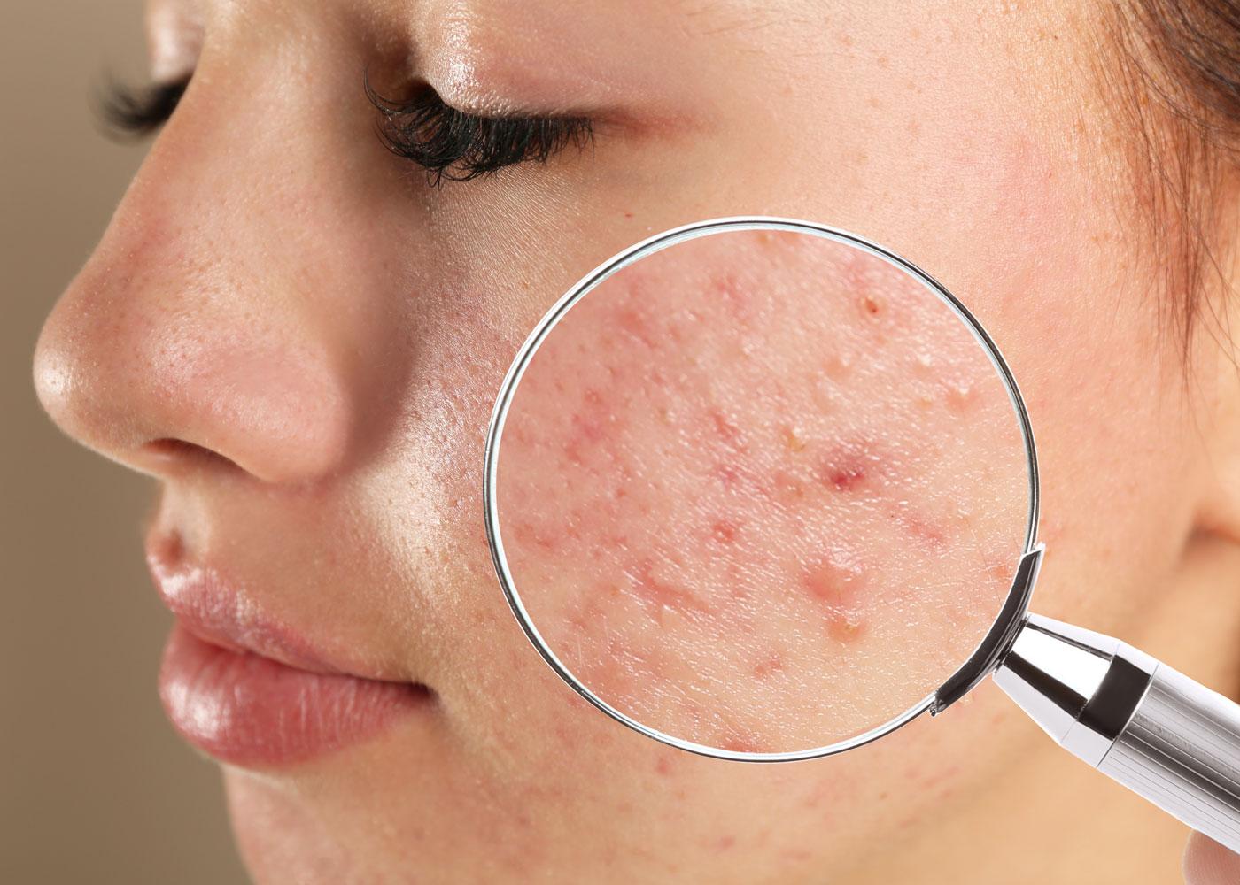 difference between fungal acne and closed comedones