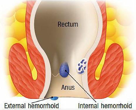 does aquaphor help with hemorrhoids