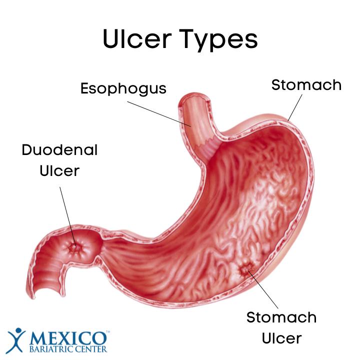 Ulcer Types