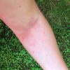 5 Natural Remedies for Poison Ivy Rashes