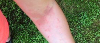 5 Natural Remedies for Poison Ivy Rashes