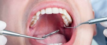 Diabetes, Gum Disease, & Other Dental Problems