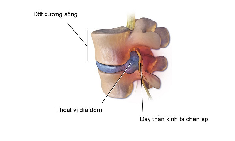 Hình ảnh mô tả vị trí đĩa đệm bị thoát vị và chèn ép dây thần kinh