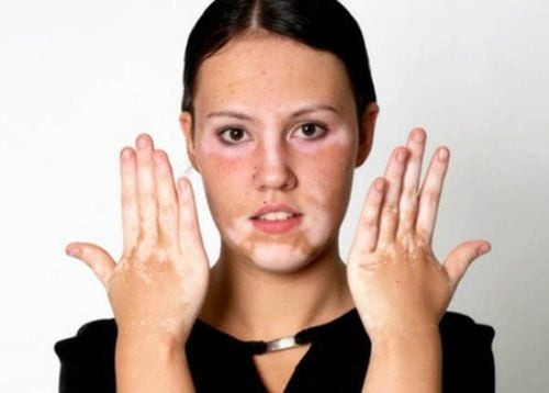 Mảng bạch biến trên da tay, thể hiện sự mất sắc tố melanin đặc trưng.